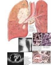 Bronchogenic Carcinoma: Small Cell Anaplastic (Oat Cell) Type