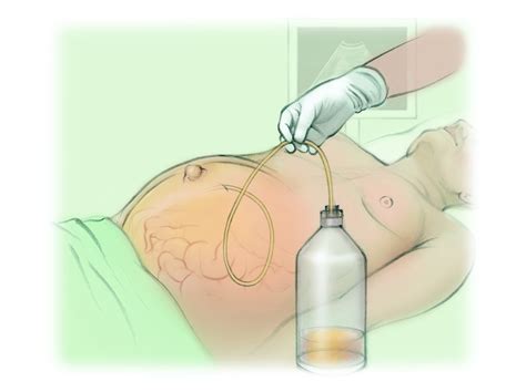 Paracentesis The Interventional Initiative