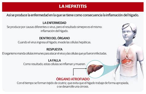 Vinculan Casos De Hepatitis Aguda Infantil Con Covid