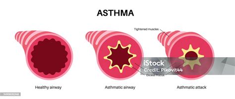 Asthma Lung Disease Stock Illustration - Download Image Now - Diagram ...