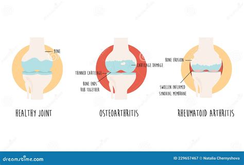 vector diagram  healthy joint  joint  osteoarthritis