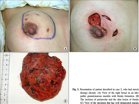 Algorithm For Management Of Idiopathic Granulomatous Mastitis