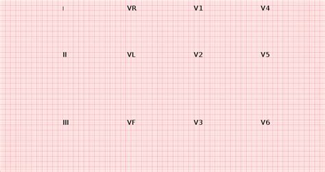 Fileecg Paper 12 Leadssvg