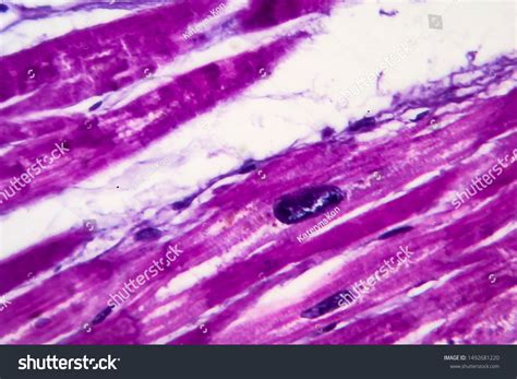 Heart Hypertrophy Histopathology Photomicrograph Showing Hypertrophic