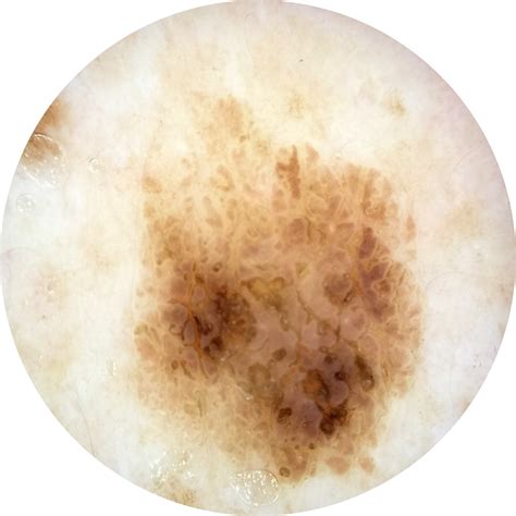 MoleScope™ | Smartphone Dermatoscope for Digital Dermoscopy