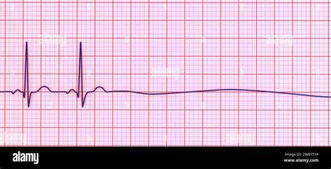 Illustration showing a flatline on an electrocardiogram (ECG ...