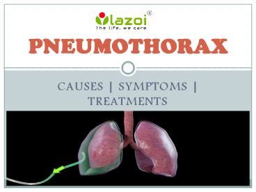 Ppt Pneumothorax Causes Symptoms Diagnosis And Treatment