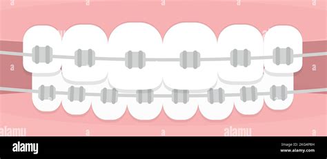 Teeth Braces Concept Of Orthodontics Horizontal Format Vector