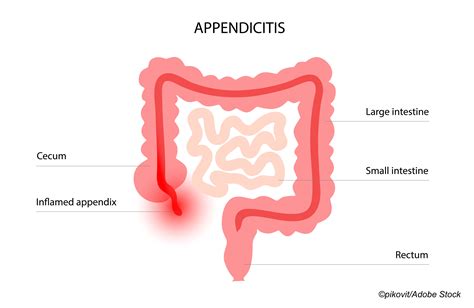 Acute Appendicitis: Looking at Treatment Options Beyond Surgery - Physician's Weekly