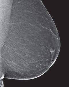 The ABCDs Of Breast Density What Is It Could Dense Breast Tissue