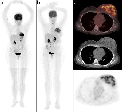 Breast Metastasis From Melanoma Mimicking Inflammatory Breast Cancer