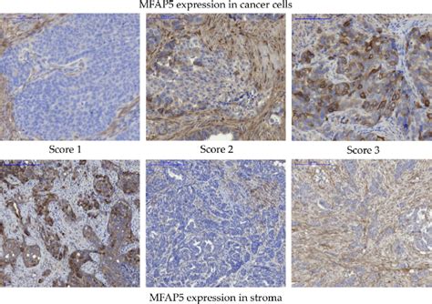 Immunohistochemical Detection Of MFAP5 In OC Samples Upper