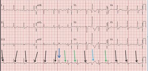 Dr. Smith's ECG Blog: AV Dissociation. Is there AV block?