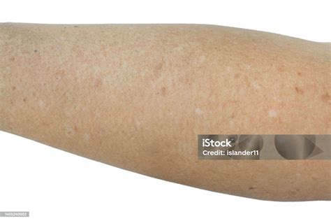 Small White And Brown Spots On The Skin Of Senior Man Arm Isolated On White Background Stock