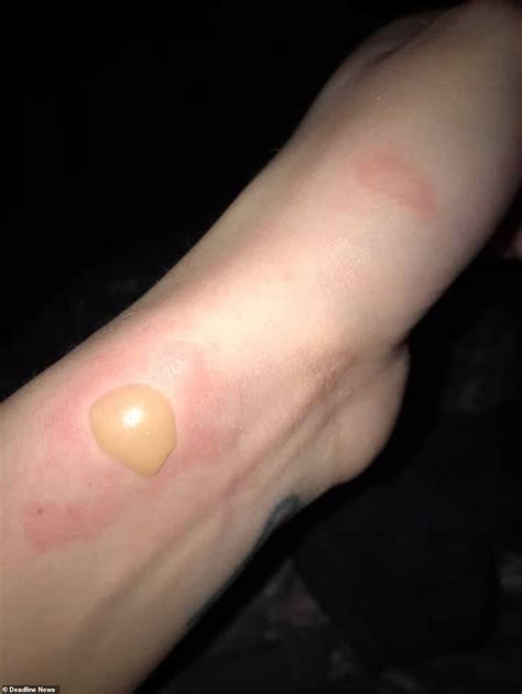 NHS Worker 29 Says She Has Been Scarred For Life By Severe Burns From Asda Hot Water Bottle