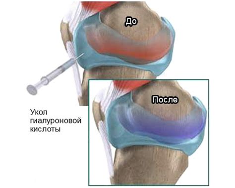 Уколы при артрите суставов: виды и применение