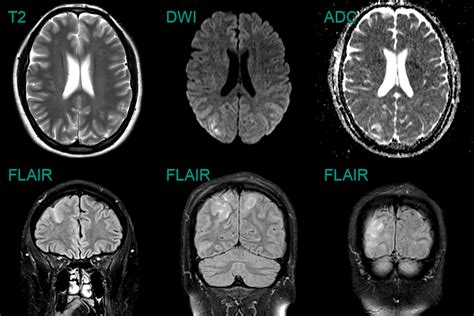 Reversible Cerebral Vasoconstriction Syndrome (RCVS) - NEURORADIOLOGY