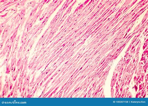 Heart Hypertrophy Photomicrograph Stock Photo Image Of Closeup Human