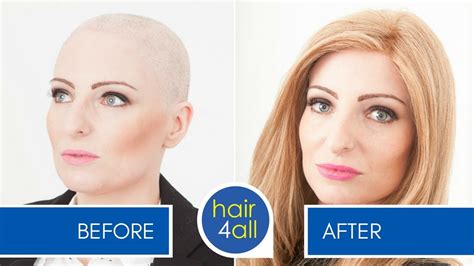 Before And After A Non Surgical Hair Replacement System For Menwomen