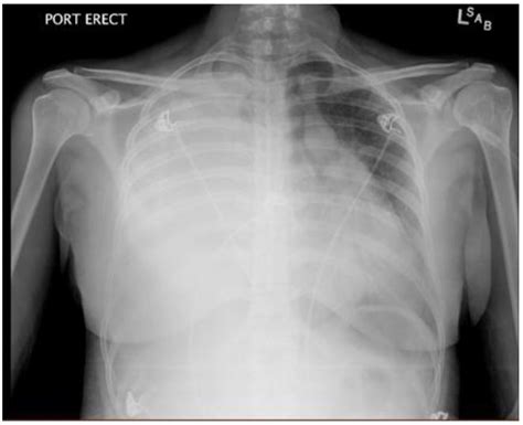 Tension Hydrothorax From Disseminated Endometriosis The Western