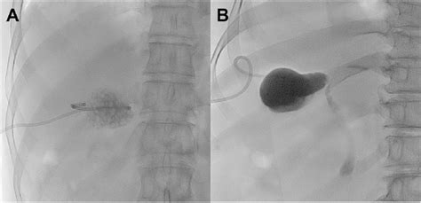 Venous Drainage Of Gallbladder