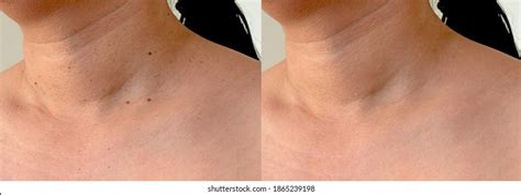 Image Compare Before After Acne Treatment Stock Photo