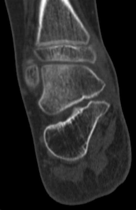 Talocalcaneal Joint Middle Facet Coalition Resection With Interposition