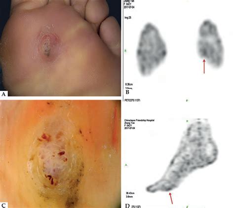 SciELO Brasil Amelanotic Acral Melanoma Misdiagnosed As Verruca