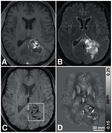 Mr Images Of A Year Old Man With A Left Occipital Untreated