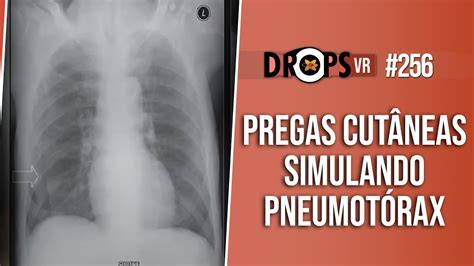 PREGAS CUTÂNEAS SIMULANDO PNEUMOTÓRAX SAIBA A DIFERENÇA YouTube