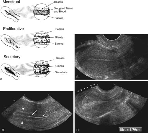 Anteverted Uterus Ultrasound