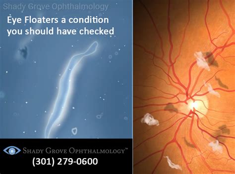 Floaters Retinal Tears Retinal Holes Shady Grove Ophthalmology