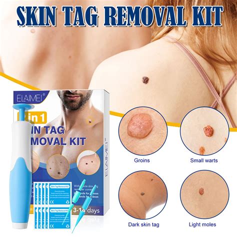 In Painless Skin Tag Mole Wart Removal X Rubber Band Comfortable