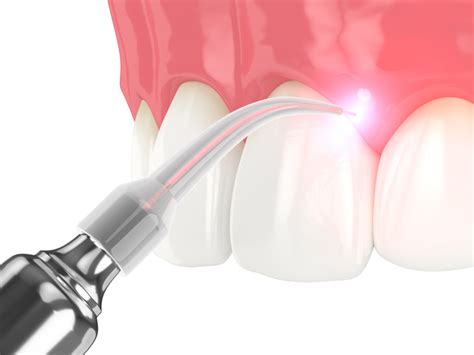 Lanap A Revolutionary Laser Gum Surgery For Gum Disease