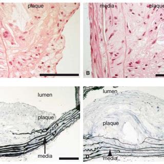 Atherosclerosis In Ldlr Panels A And C And Plin Ldlr Panels