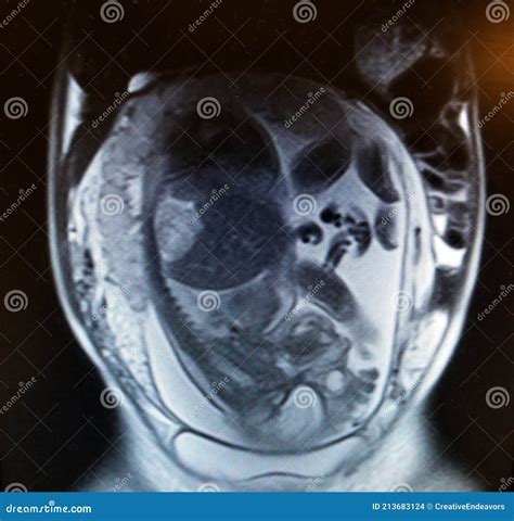 Baby Mri Scan Price Deafening Bloggers Pictures