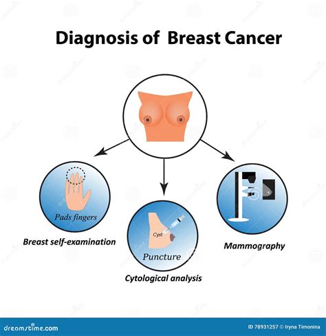 Se La Biopsia Al Seno E Positiva Ti Chiamano Subito 9