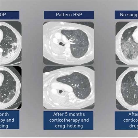 PDF Management Of Pulmonary Toxicity Associated With Immune