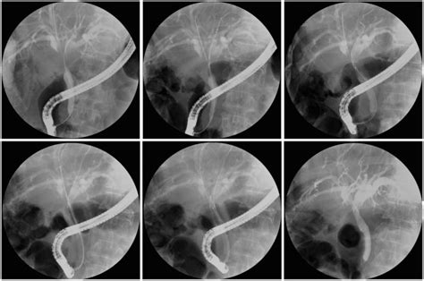 Endoscopic Placement Of Bilateral Metal Stenting Using Two Biliary