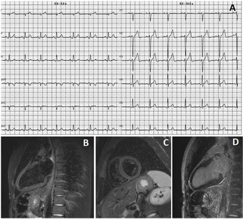 A Ecg Showing Sinus Rhythm Mild St Segment Elevation And Diphasic T