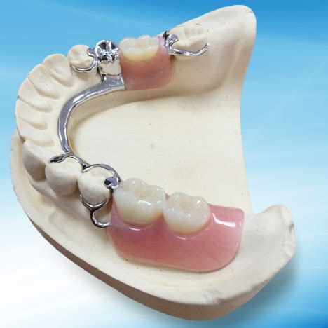 China Natural Cast Metal Partial Denture Manufacturers, Suppliers ...