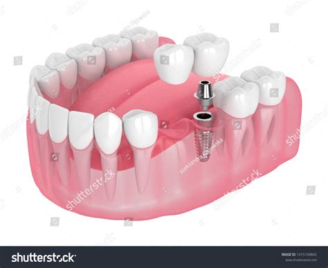 D Render Jaw Implant Supported Dental Stock Illustration