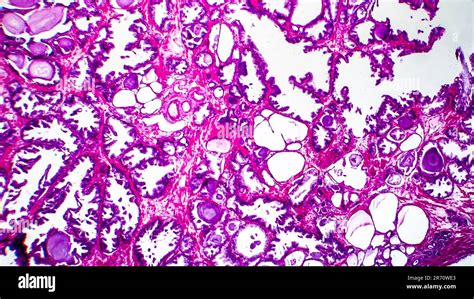 Histopathology Of Prostate Gland Hyperplasia Light Micrograph Photo