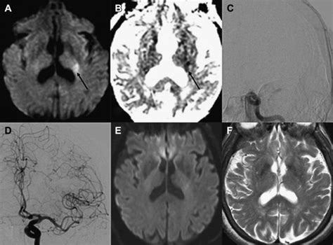 Clinical Applications Of Diffusion Mr Imaging For Acute Ischemic Stroke