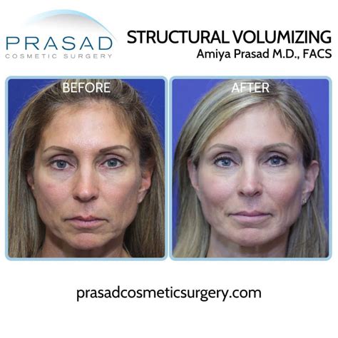 Asymmetrical Face Surgery Before And After