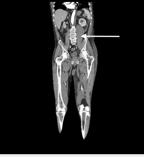 Coronal view of retroperitoneal hematoma. | Download Scientific Diagram