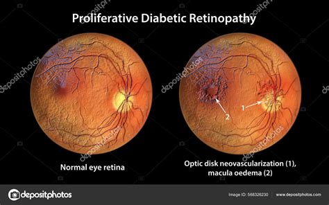 Retinopatía Diabética Proliferativa Ilustración Que Muestra