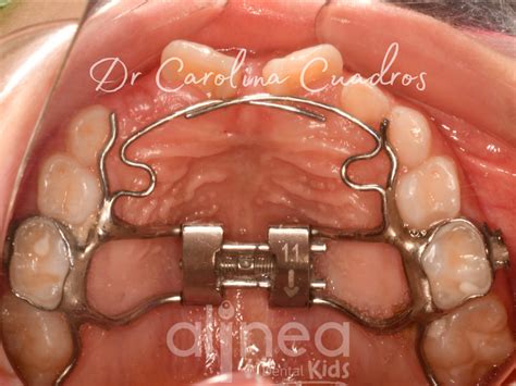 Expansores de Paladar en Niños La Clave para una Sonrisa Saludable con