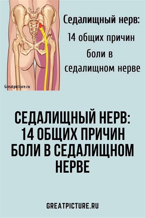 Седалищный нерв: 14 общих причин боли в седалищном нерве | Седалищный ...