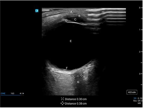 Life Free Full Text A Narrative Review Of Point Of Care Ultrasound Assessment Of The Optic